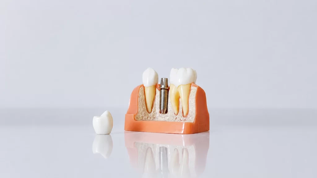 dental implants dubai