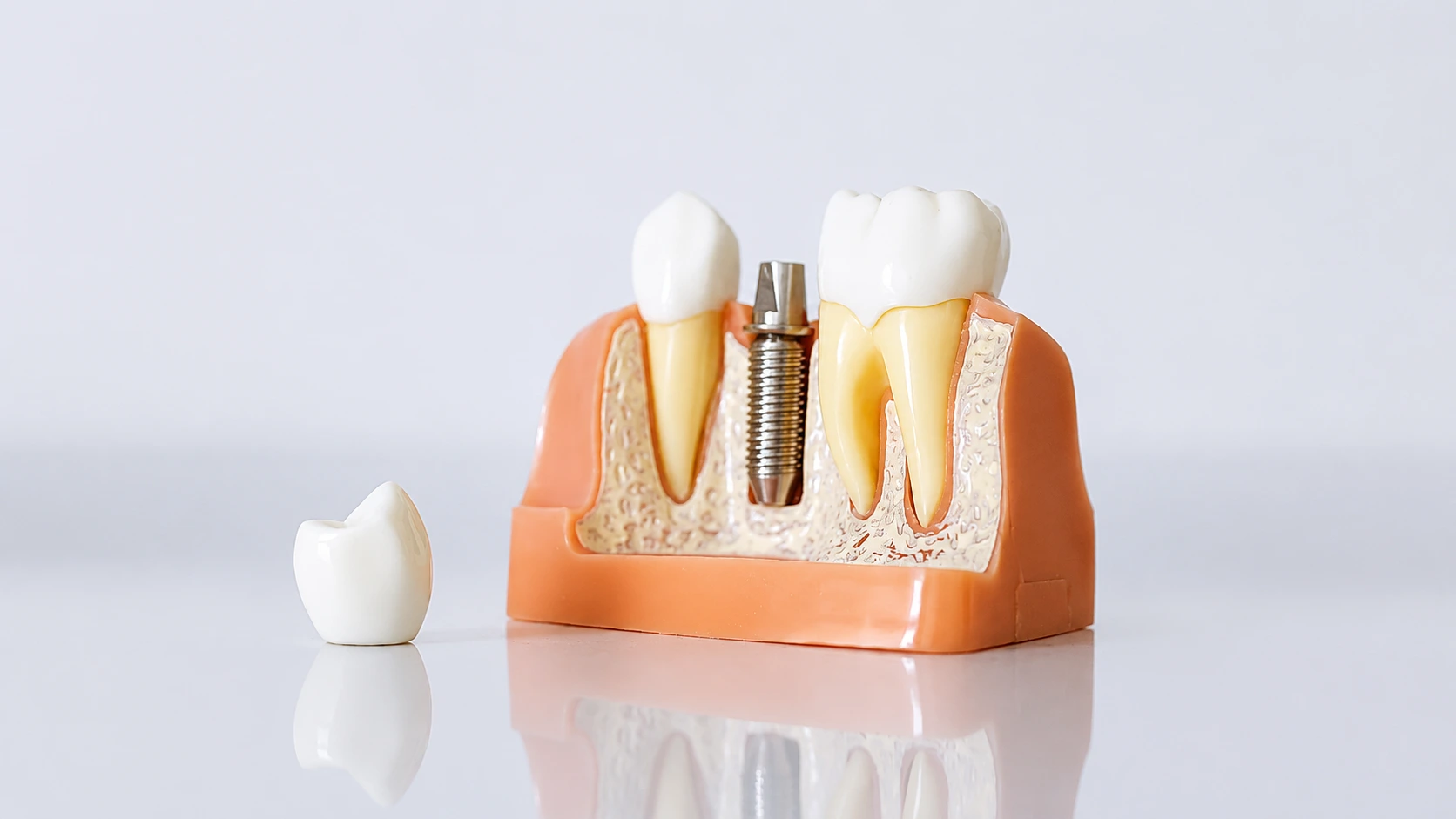 dental implants in dubai
