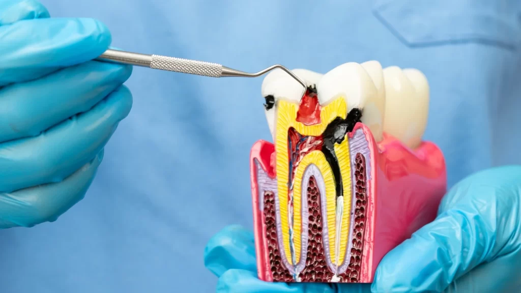 root canal treatment