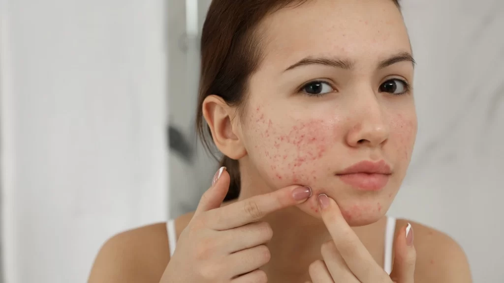 Acne Scar Treatment